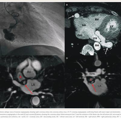 Figure 2 Imaging in the Diagnosis of Coronary Artery Fistula
