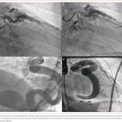 Figure 5 Examples of Simple and Complex Coronary Artery Fistula