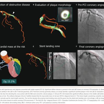 Figure 5 Representative Cases of CT-Guided Percutaneous Coronary Intervention in Complex Lesion