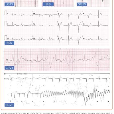 Figure 1 Characteristic ECG Findings of Inherited Primary Arrhythmia Syndromes