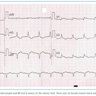 Figure 1 ECG at the Emergency Room of a Patient with Multisystem Inflammatory Syndrome