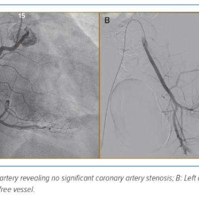 Figure 2 Coronary Angiogram of a Patient with Multisystem Inflammatory Syndrome