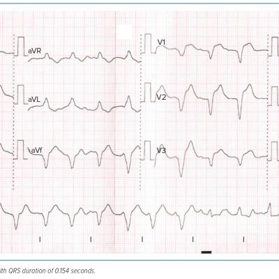 Figure 3 ECG of the Patient on Day 2 of Admission