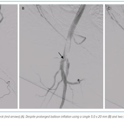 Figure 2 Digital Subtraction Angiography of the Right Femoral Artery and its Tributaries