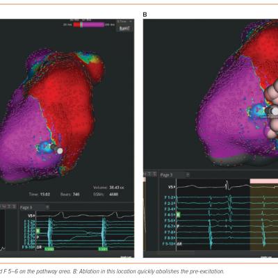 Figure 4 Case 4 – Open Window Mapping of a Manifest Left Lateral Accessory Pathway Using the Rhythmia Mapping System