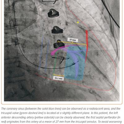 Figure 5 Right Anterior Oblique Projection Demonstrating Several Fluoroscopic Landmarks Can be Used to Avoid Procedure-related Complications During Left Bundle Branch Area Pacing
