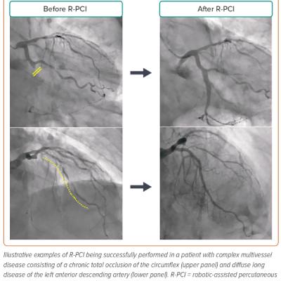 Figure 3 Case Examples of Complex Robotic assisted Percutaneous Coronary Intervention
