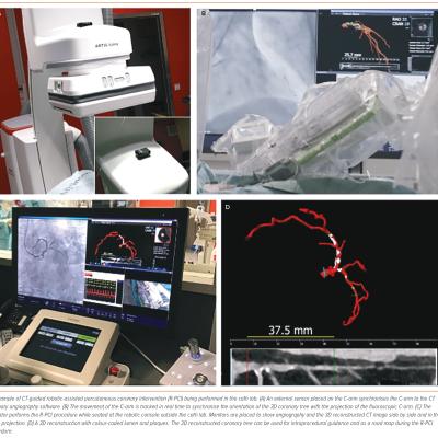 Figure 4 CT-guided Robotic-assisted Percutaneous Coronary Intervention