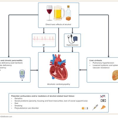 Figure 2 Possible Contributors Effect Modifiers and Confounders Linking Excessive Alcohol Intake with Cardiomyopathy