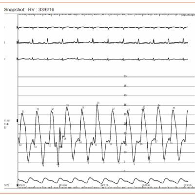 Figure 2 Right Ventricular Pressure Tracing