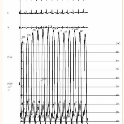 Figure 3 Simultaneous Right Ventricular and Left Ventricular Pressure Tracings