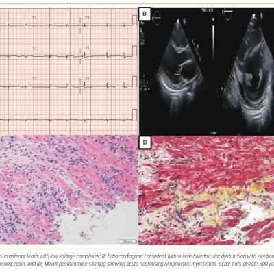 Figure 1 Electrocardiogram Echocardiogram and Biopsy Findings in Our Case