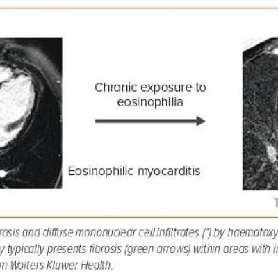 Figure 4 Eosinophilic Myocarditis