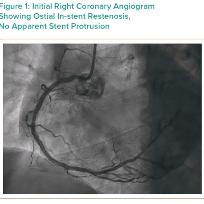 Figure 1 Initial Right Coronary Angiogram Showing Ostial In-stent Restenosis No Apparent Stent Protrusion