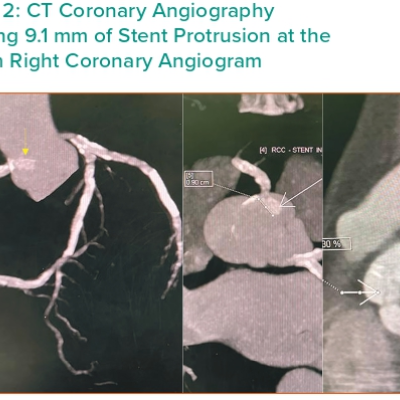 Figure 2 CT Coronary Angiography Showing 9.1 mm of Stent Protrusion at the Ostium Right Coronary Angiogram