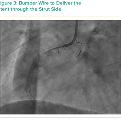 Figure 3 Bumper Wire to Deliver the Stent through the Strut Side