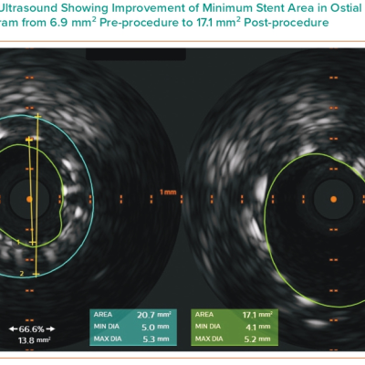 Figure 4 Intravascular Ultrasound Showing Improvement of Minimum Stent Area in Ostial Right Coronary Angiogram from 6.9 mm2 Pre-procedure to 17.1 mm2 Post-procedure