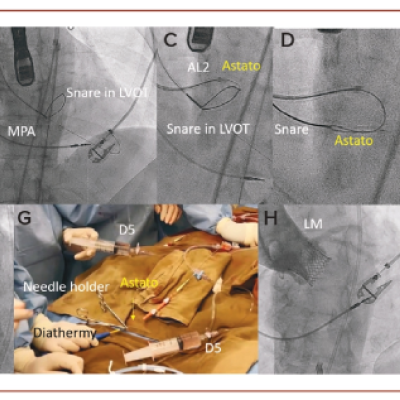 Figure 2 Procedural Highlights of Intentional Aortic Leaflet Laceration Followed by Transcatheter Aortic Valve Implantation