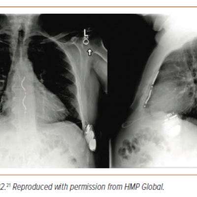 Figure 2 Anterior–Posterior Chest Radiograph of a Subcutaneous Implantable Defibrillator