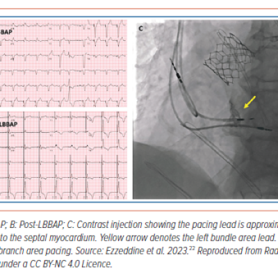 Figure 3 Cardiac Resynchronisation with Left Bundle Branch Area Pacing in a Patient with Pacing-induced Cardiomyopathy