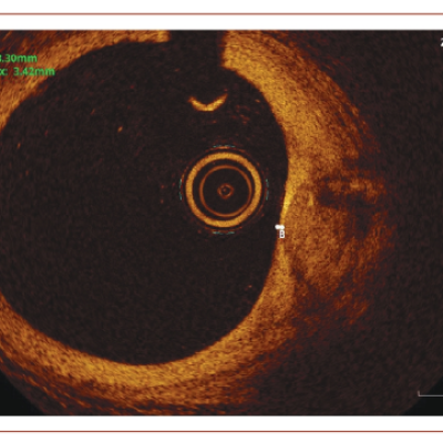 Figure 2 Unstable Plaque on Optical Coherence Tomography