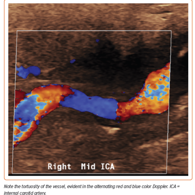 Figure 1 Color Doppler Ultrasound of the Internal Carotid Artery in a Patient with Fibromuscular Dysplasia