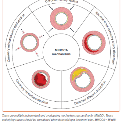 Figure 1 Mechanisms of MINOCA