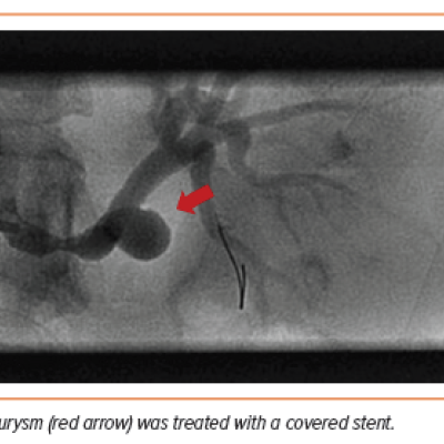 Figure 2 Left Renal Angiogram of Renal Artery Aneurysm in a Patient with Fibromuscular Dysplasia