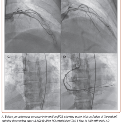 Figure 3 Coronary Angiogram Before and After Percutaneous Coronary Intervention