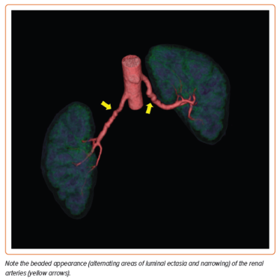 Figure 3 Volumetric Visualization of CT Angiography Data of a Patient with Renal Artery Fibromuscular Dysplasia
