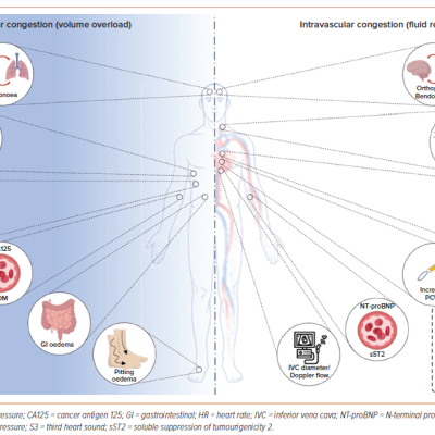 Figure 1 Main Clinical Biochemical and Physical Correlates of Intravascular and Extravascular Congestion Among Patients with Heart Failure