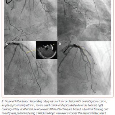 Figure 1 Subintimal Tracking and Re-entry-based Chronic Total Occlusion Recanalization