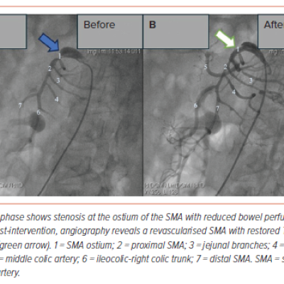 Figure 1 Superior Mesenteric Artery Angiography in Case 1