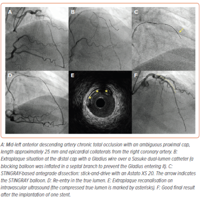 Figure 2 STINGRAY-based Chronic Total Occlusion Recanalization