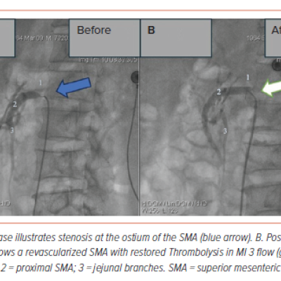 Figure 2 Superior Mesenteric Artery Angiography in Case 2