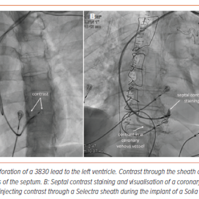 Figure 3 Septal Perforation and Septal Contrast Staining