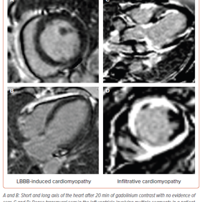 Figure 4 Cardiac MRI in Non-ischaemic Cardiomyopathy