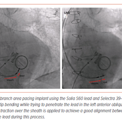 Figure 4 Importance of Lead–Sheath and Septal Alignment During Left Bundle Branch Area Pacing Using Stylet-driven Leads