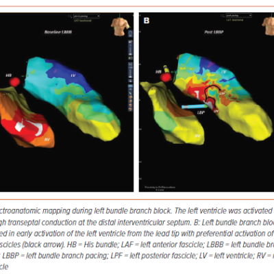 Figure 5 Electroanatomic Mapping During Left Bundle Branch Block