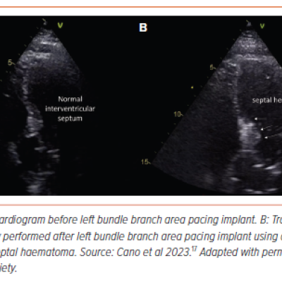 Figure 5 Septal Hematoma During Left Bundle Branch Area Pacing