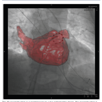 Figure 1 3D Reconstruction of Left Ventricular and Pulmonary Vein Anatomy from Rotational Angiography