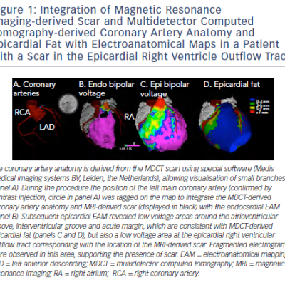 Figure 1 Integration of Magnetic Resonance Imaging-derived Scar and Multidetector Computed Tomography-derived Coronary Artery Anatomy and Epicardial Fat with Electroanatomical Maps in a Patient with a Scar in the Epicardial Right Ventricle Outflow Tract