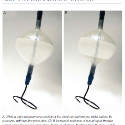 The Second-generation Cryoballoon