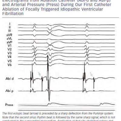 Figure 1 Twelve-lead Electrocardiogram with Intracardiac Electrograms from Ablation Catheter Abl-d and Abl-p and Arterial Pressure Press During Our First Catheter Ablation of Focally Triggered Idiopathic Ventricular Fibrillation