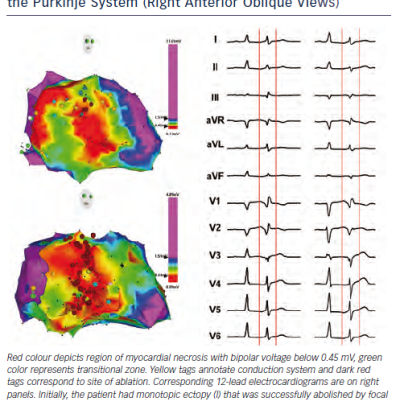 Figure 2 Electroanatomical Maps of the Left Ventricle in a Patient After Previous Myocardial Infarction Depicting Location of the Triggering Foci From Different Regions of the Purkinje System Right Anterior Oblique Views