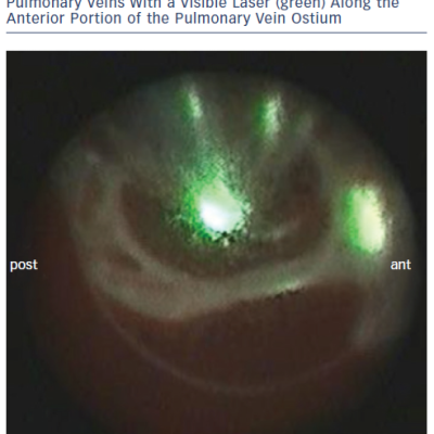 Endoscopic View of a Pair of Left-sided Pulmonary Veins With a Visible Laser green Along the Anterior Portion of the Pulmonary Vein Ostium