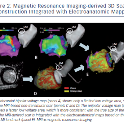 Figure 2 Magnetic Resonance Imaging-derived 3D Scar Reconstruction Integrated with Electroanatomic Mapping