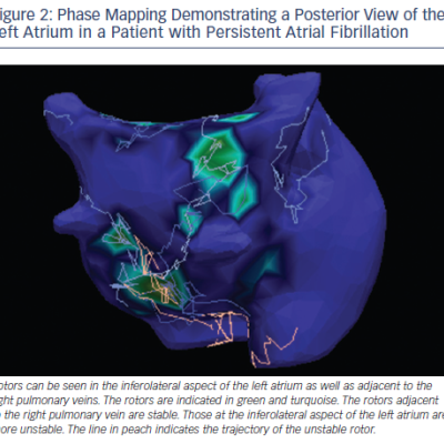 Figure 2 Phase Mapping Demonstrating a Posterior View of the Left Atrium in a Patient with Persistent Atrial Fibrillation