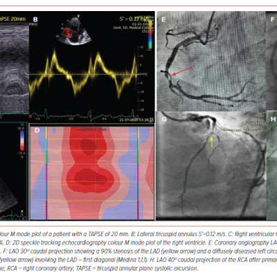 Figure 2 Significance of Low RVfwLS with Normal Conventional Echocardiographic Parameters in Triple Vessel Disease