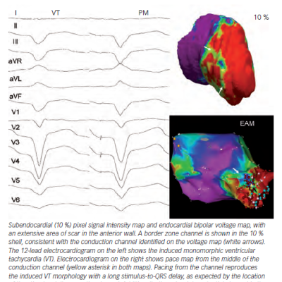 Figure 3 Magnetic Resonance Imaging-based Border Zone Channel Identification